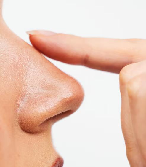 Giba no dorso nasal - Dra. Lumy Yagueshita